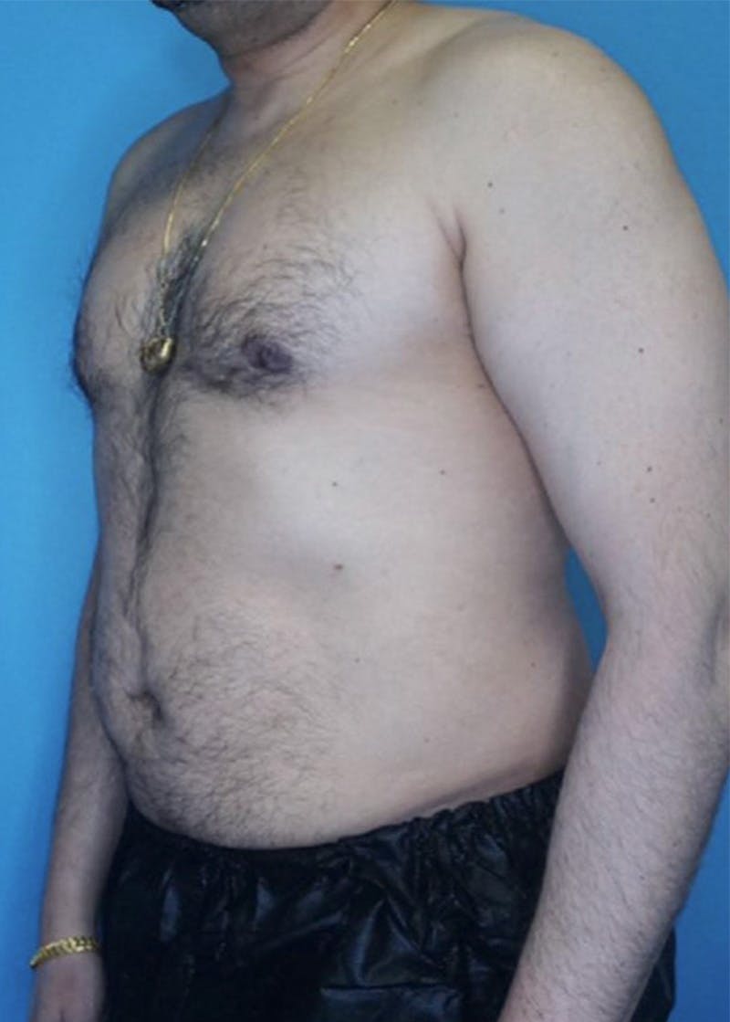 Vaser Liposuction Before & After Gallery - Patient 86837155 - Image 1