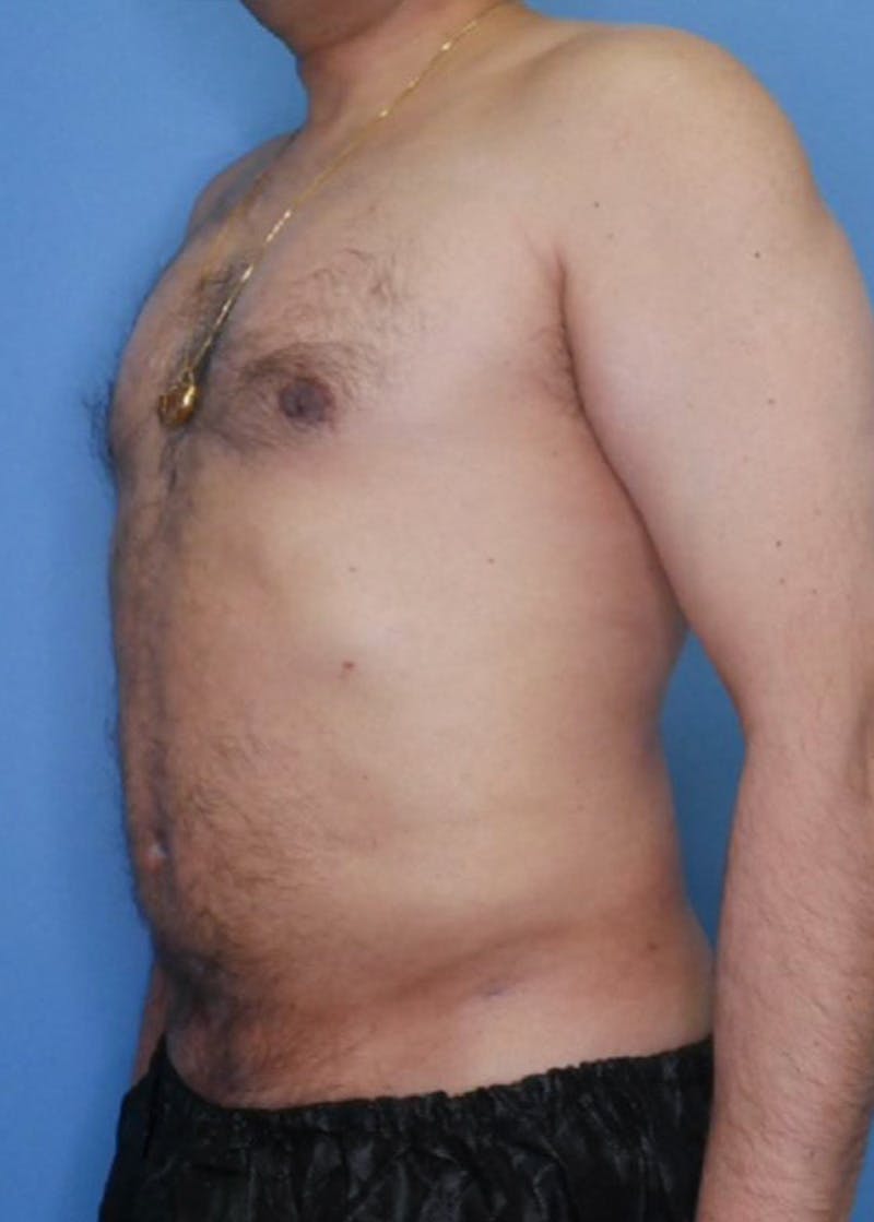Vaser Liposuction Before & After Gallery - Patient 86837155 - Image 2