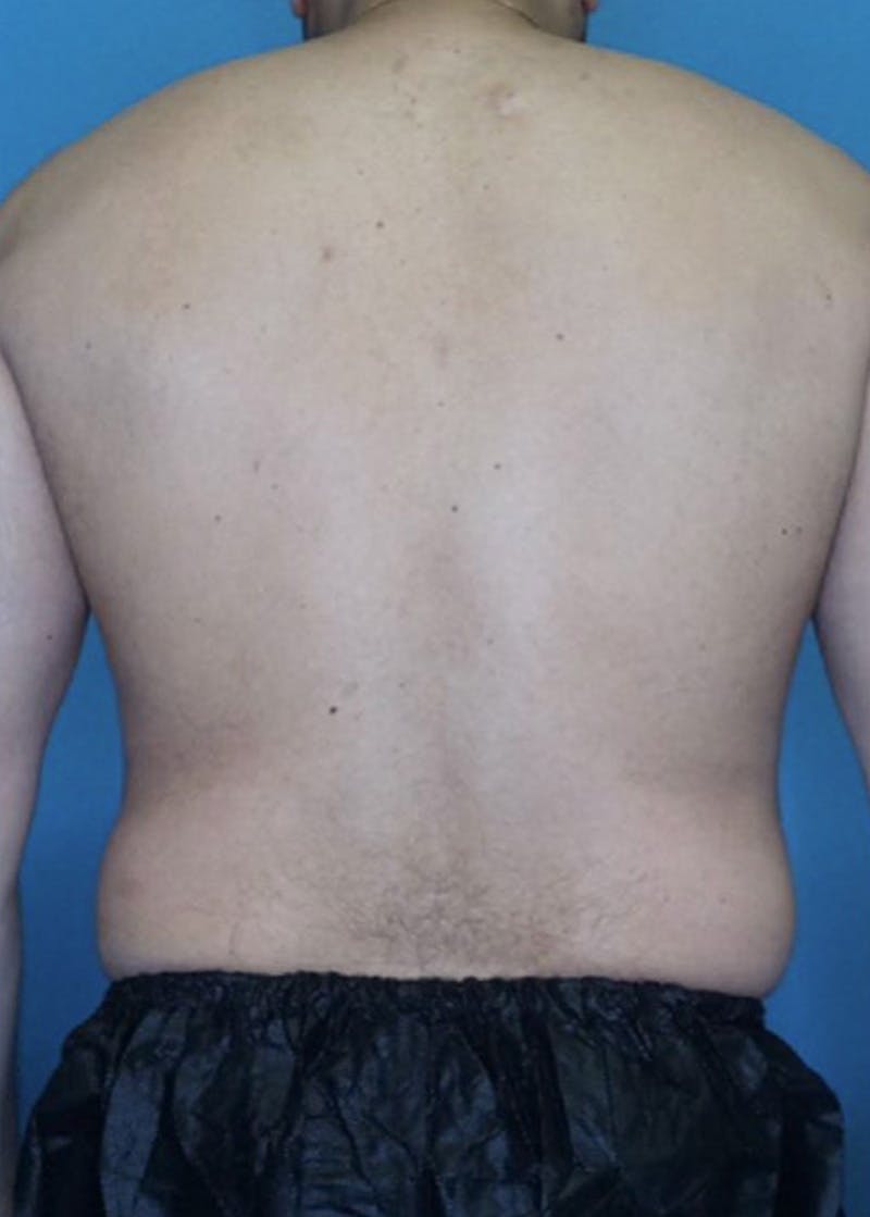 Vaser Liposuction Before & After Gallery - Patient 86837155 - Image 3