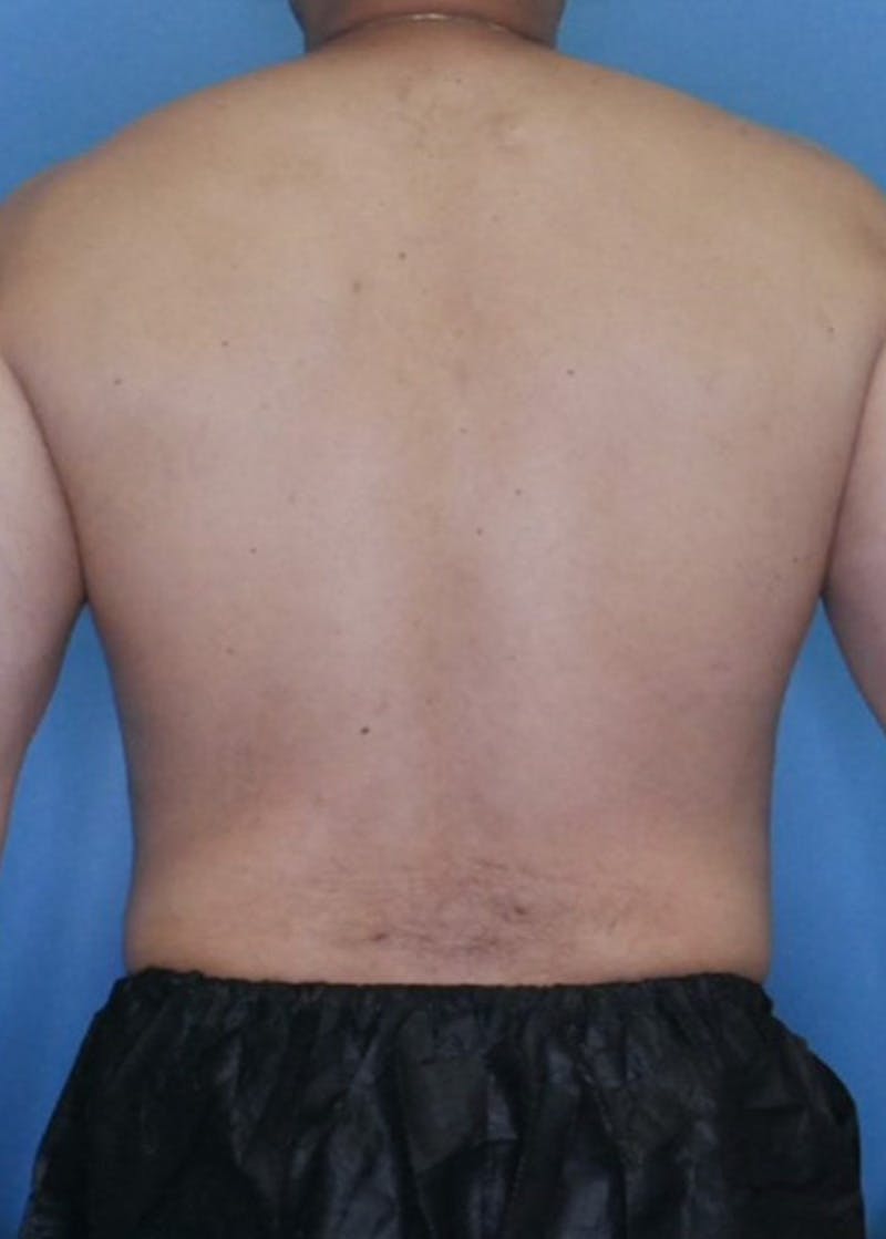Vaser Liposuction Before & After Gallery - Patient 86837155 - Image 4