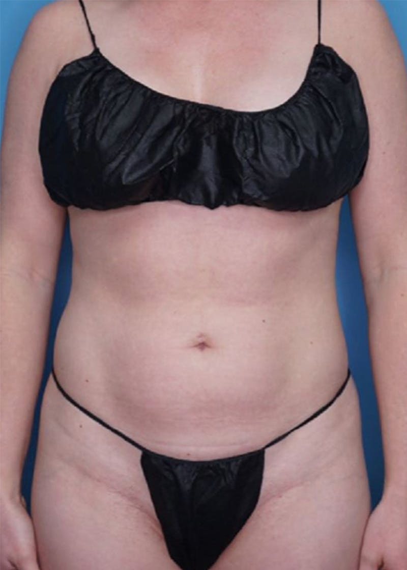 Vaser Liposuction Before & After Gallery - Patient 86764305 - Image 1