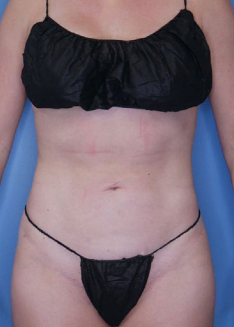Vaser Liposuction Before & After Gallery - Patient 86764305 - Image 2