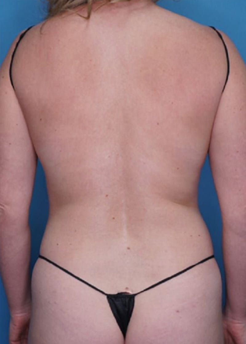 Vaser Liposuction Before & After Gallery - Patient 86764305 - Image 3