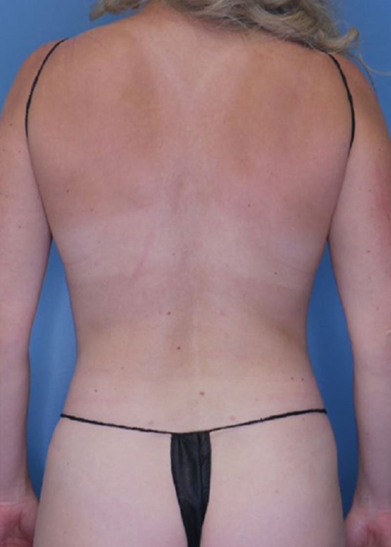 Vaser Liposuction Before & After Gallery - Patient 86764305 - Image 4