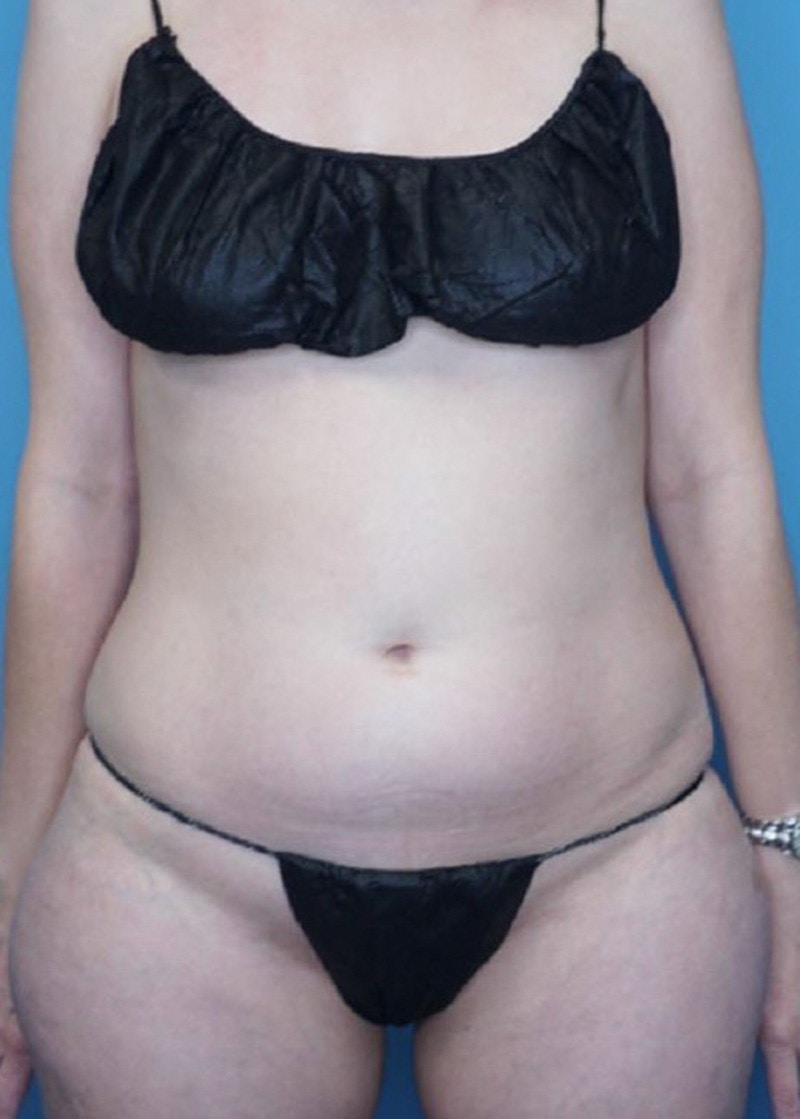 Vaser Liposuction Before & After Gallery - Patient 86645093 - Image 1