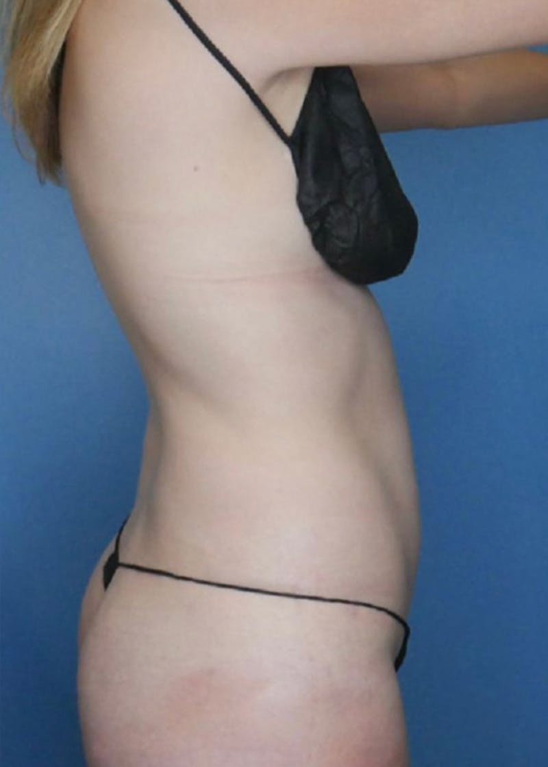 Vaser Liposuction Before & After Gallery - Patient 86645093 - Image 3