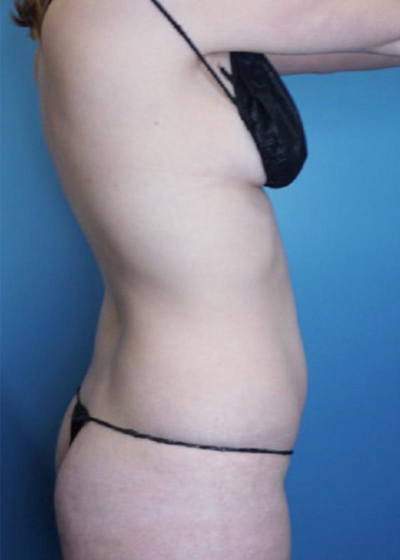 Vaser Liposuction Before & After Gallery - Patient 86645093 - Image 4