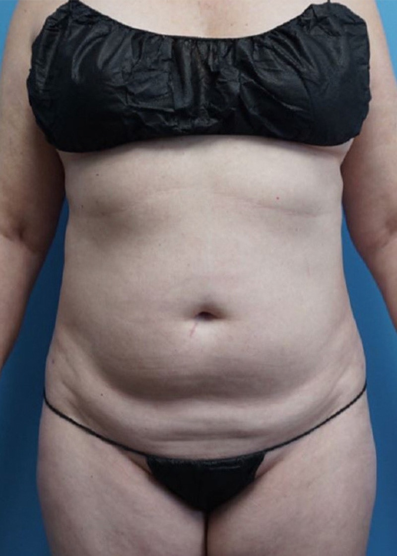 Vaser Liposuction Before & After Gallery - Patient 86645072 - Image 1