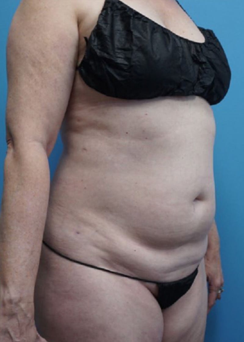 Vaser Liposuction Before & After Gallery - Patient 86645072 - Image 3