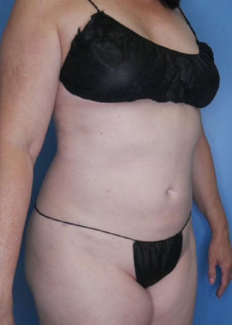 Vaser Liposuction Before & After Gallery - Patient 86645072 - Image 4