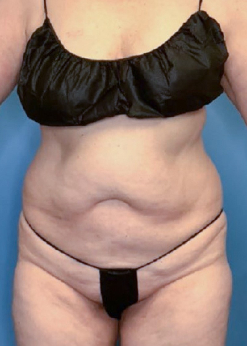 Vaser Liposuction Before & After Gallery - Patient 86645071 - Image 1