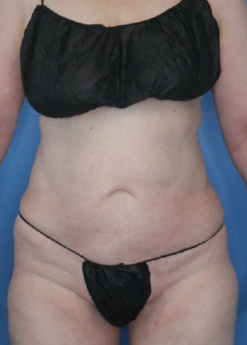 Vaser Liposuction Before & After Gallery - Patient 86645071 - Image 2