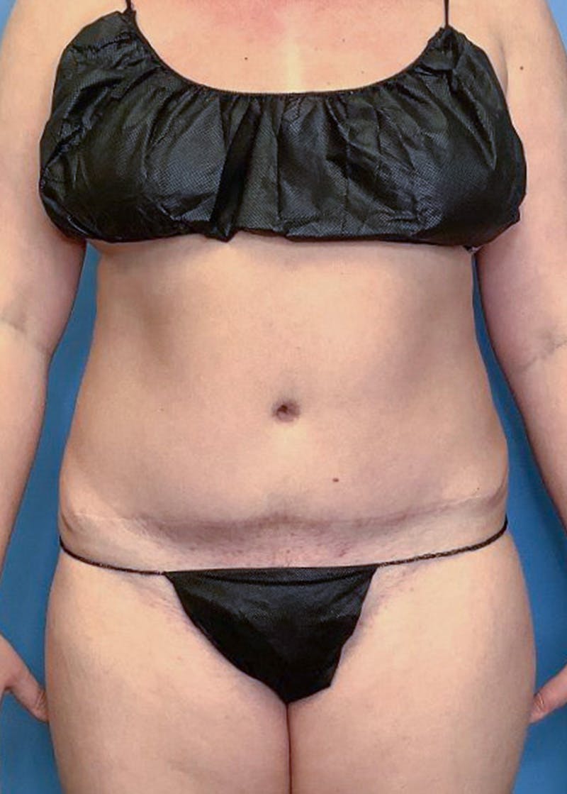Vaser Liposuction Before & After Gallery - Patient 86645068 - Image 1