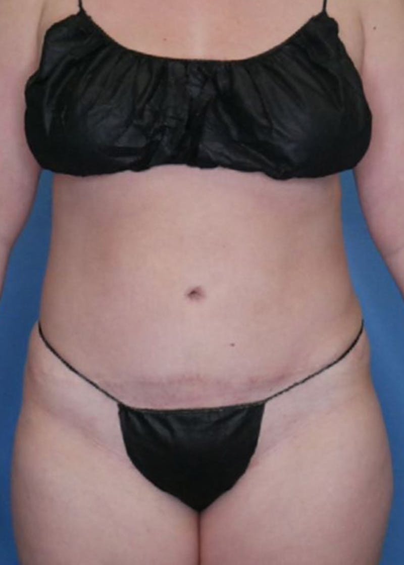 Vaser Liposuction Before & After Gallery - Patient 86645068 - Image 2