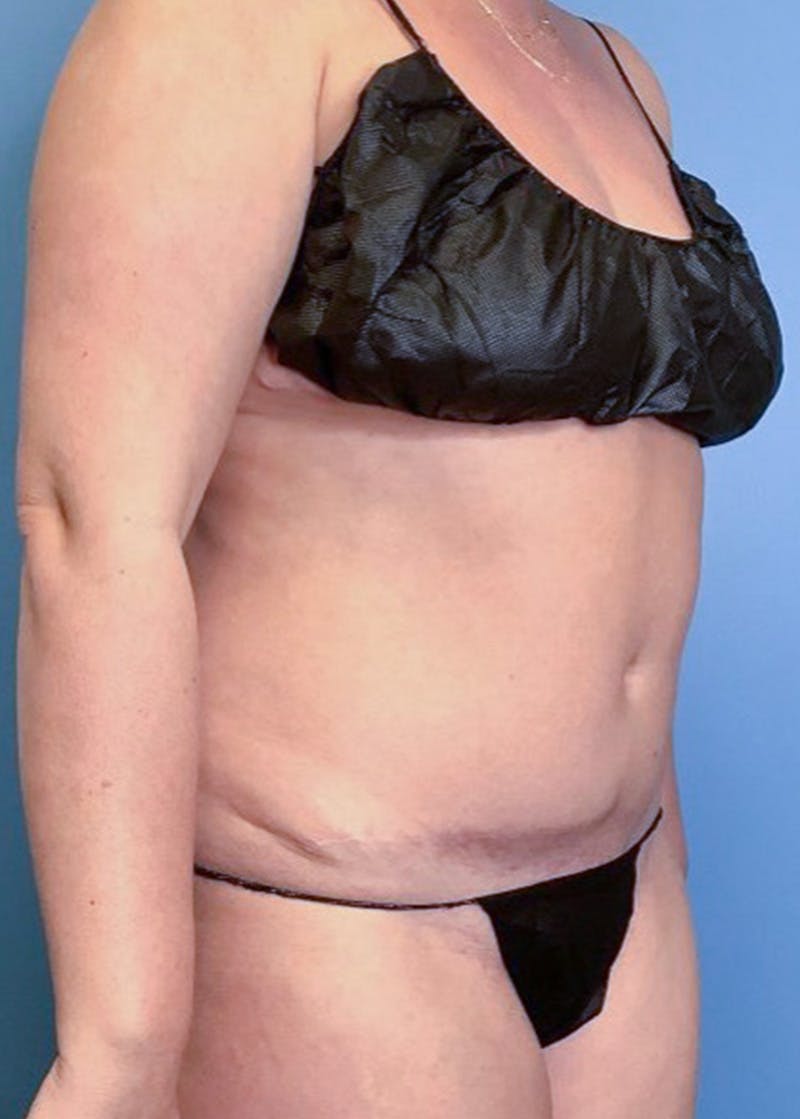 Vaser Liposuction Before & After Gallery - Patient 86645068 - Image 3