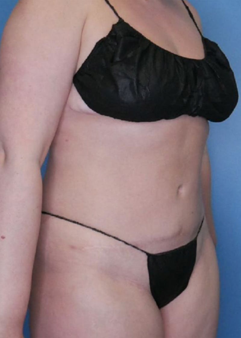 Vaser Liposuction Before & After Gallery - Patient 86645068 - Image 4
