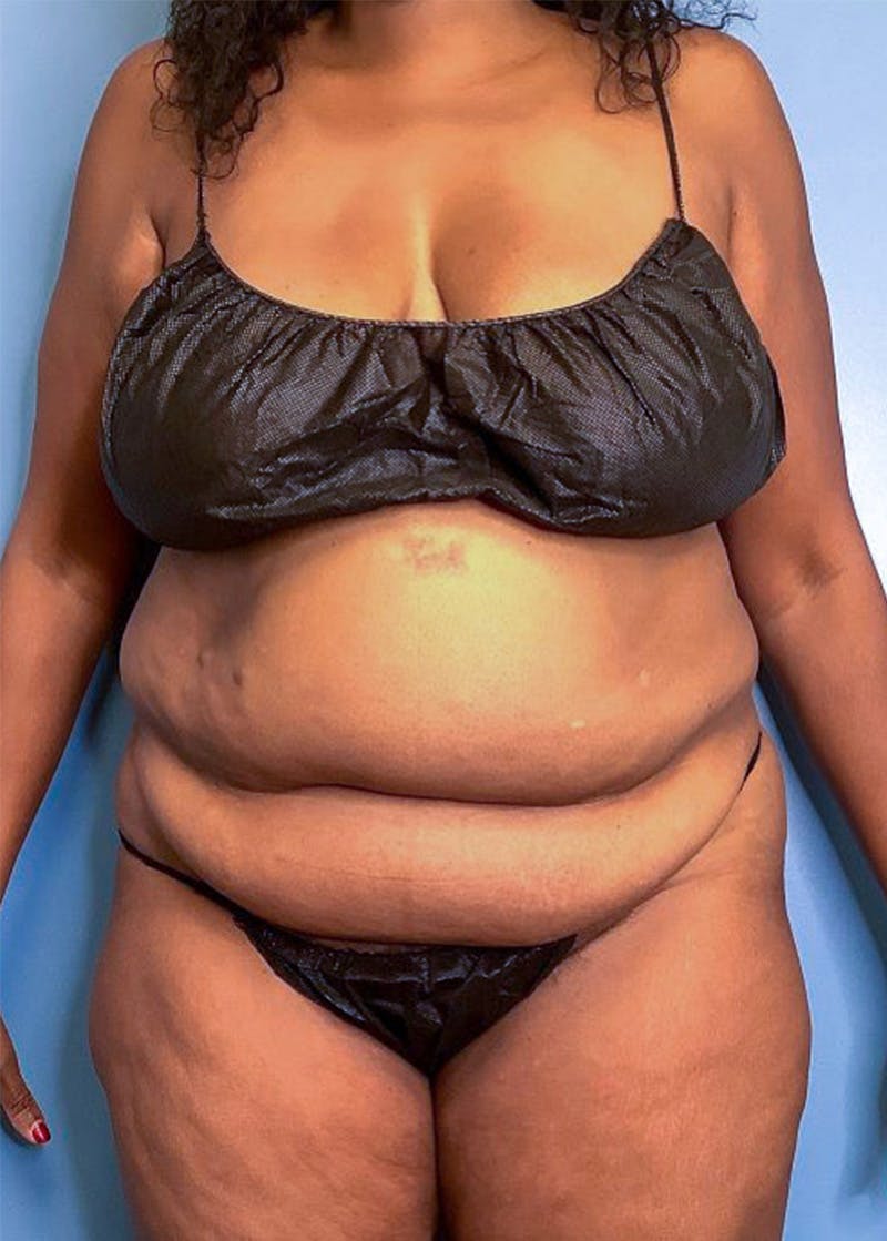 Vaser Liposuction Before & After Gallery - Patient 84287839 - Image 1