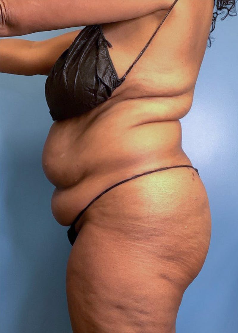 Vaser Liposuction Before & After Gallery - Patient 84287839 - Image 3