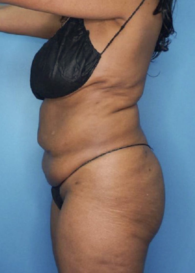 Vaser Liposuction Before & After Gallery - Patient 84287839 - Image 4