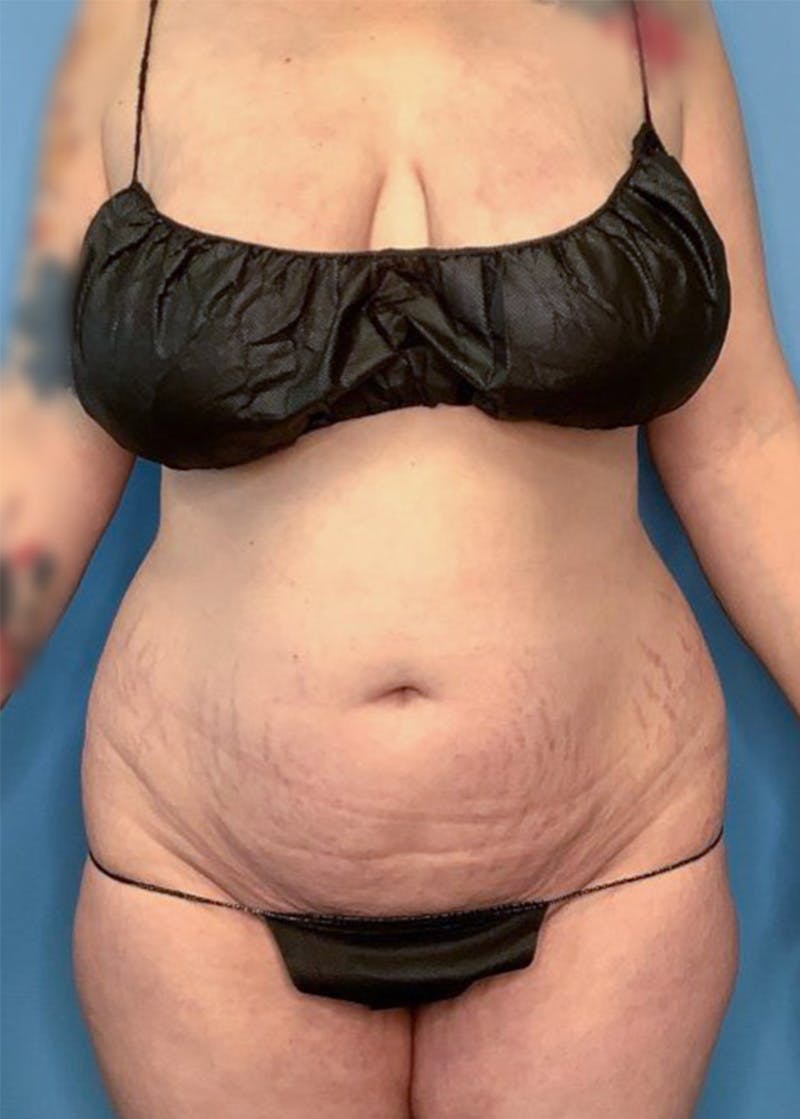 Vaser Liposuction Before & After Gallery - Patient 83594371 - Image 1