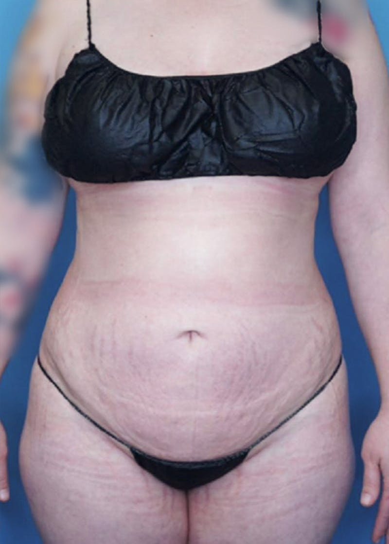 Vaser Liposuction Before & After Gallery - Patient 83594371 - Image 2