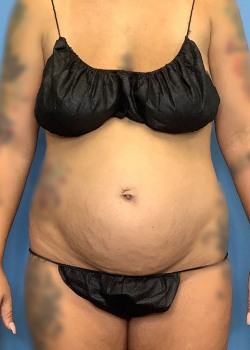 Vaser Liposuction Before & After Gallery - Patient 76667870 - Image 1