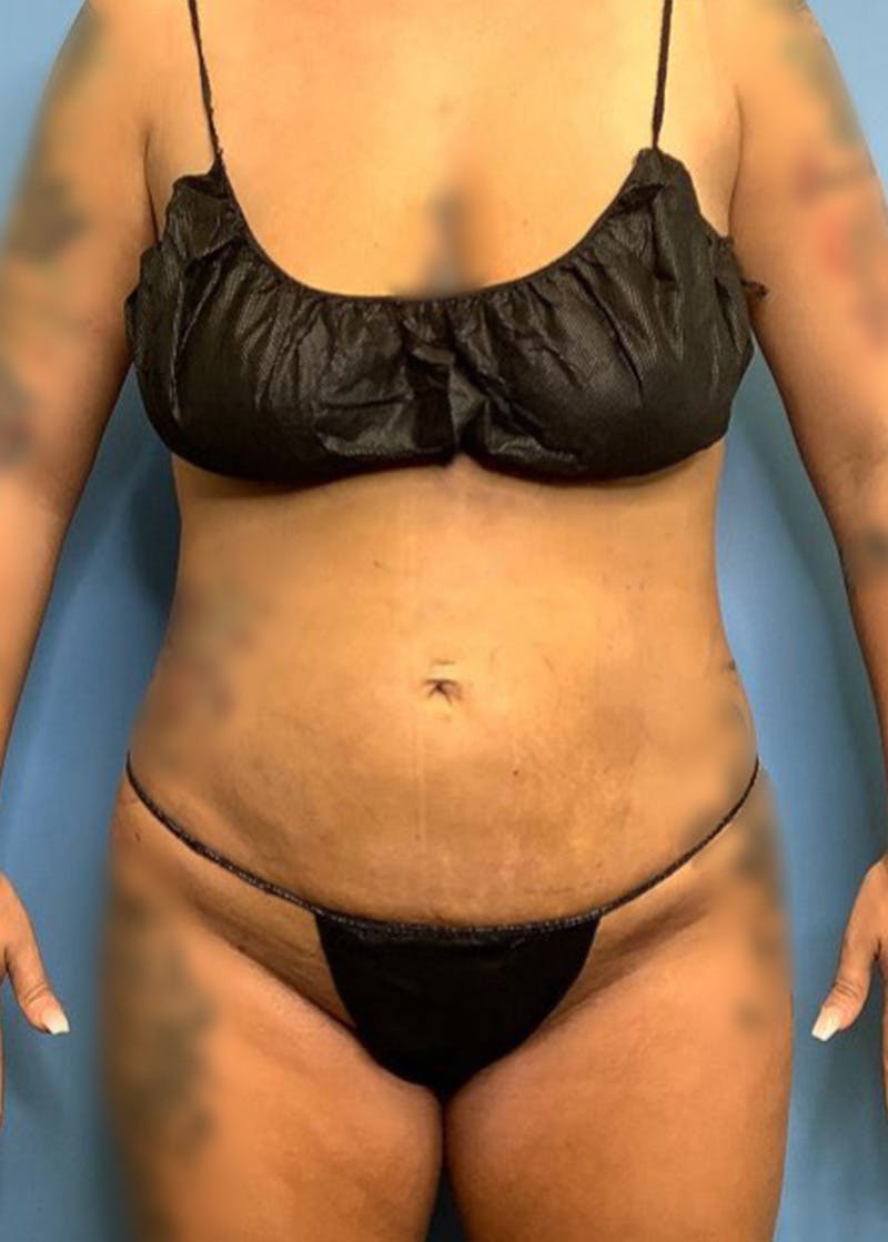 Vaser Liposuction Before & After Gallery - Patient 76667870 - Image 2