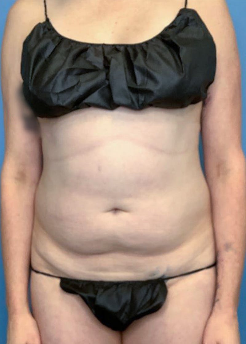 Vaser Liposuction Before & After Gallery - Patient 76667885 - Image 1