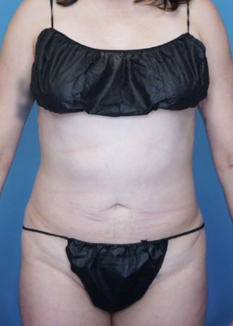 Vaser Liposuction Before & After Gallery - Patient 76667885 - Image 2
