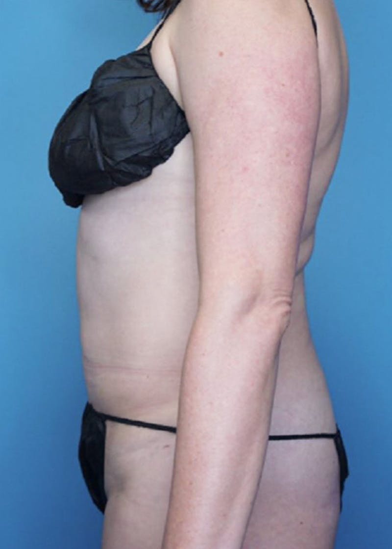 Vaser Liposuction Before & After Gallery - Patient 76667885 - Image 4