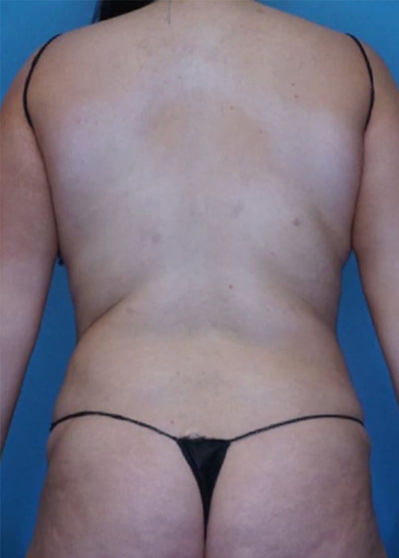 Vaser Liposuction Before & After Gallery - Patient 86645064 - Image 1