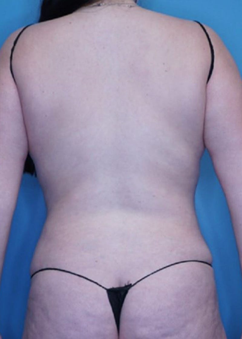 Vaser Liposuction Before & After Gallery - Patient 86645064 - Image 2