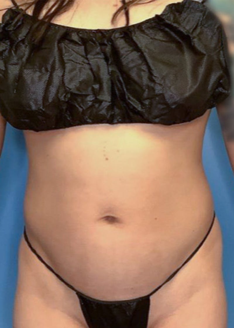 Vaser Liposuction Before & After Gallery - Patient 86645065 - Image 1