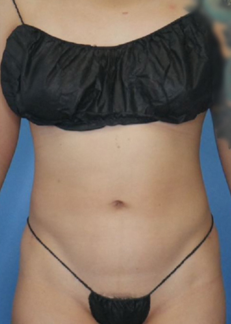Vaser Liposuction Before & After Gallery - Patient 86645065 - Image 2