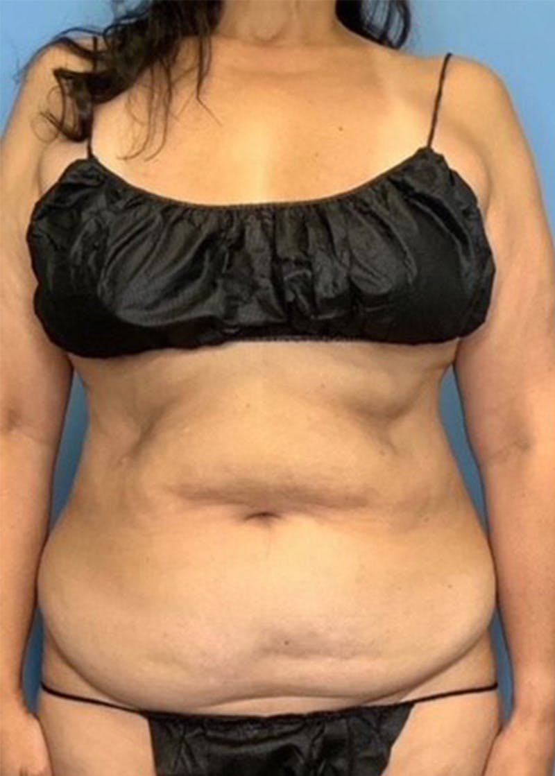 Vaser Liposuction Before & After Gallery - Patient 55612928 - Image 1