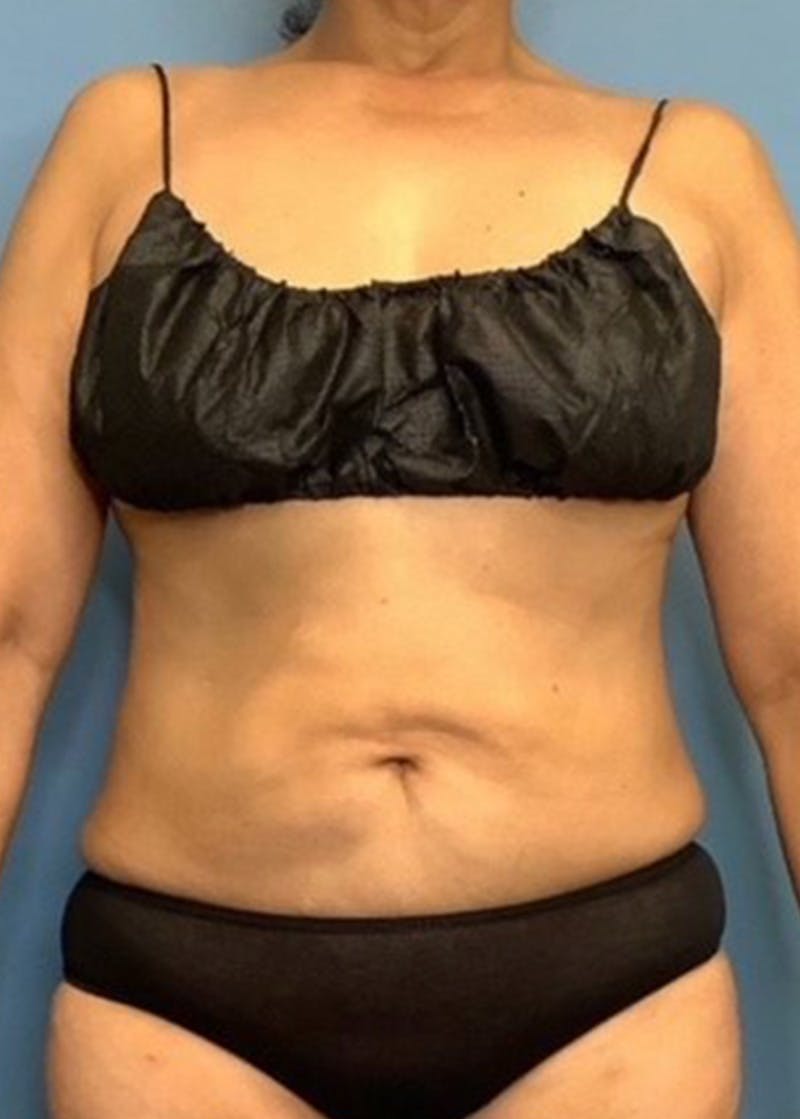 Vaser Liposuction Before & After Gallery - Patient 55612928 - Image 2