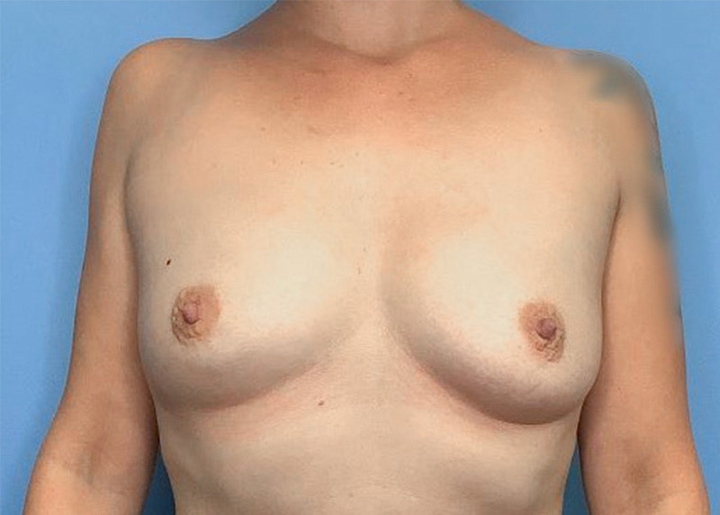 Breast Augmentation Before & After Gallery - Patient 77849549 - Image 1