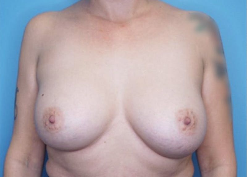 Breast Augmentation Before & After Gallery - Patient 77849549 - Image 2