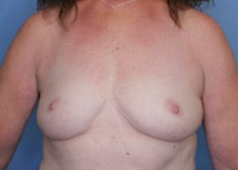 Breast Augmentation Before & After Gallery - Patient 83307256 - Image 1