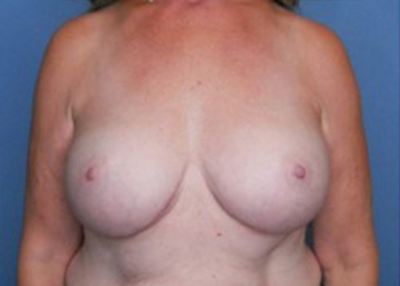 Breast Augmentation Before & After Gallery - Patient 83307256 - Image 2