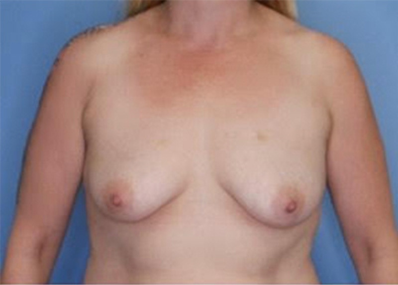 Breast Augmentation Before & After Gallery - Patient 79321588 - Image 1