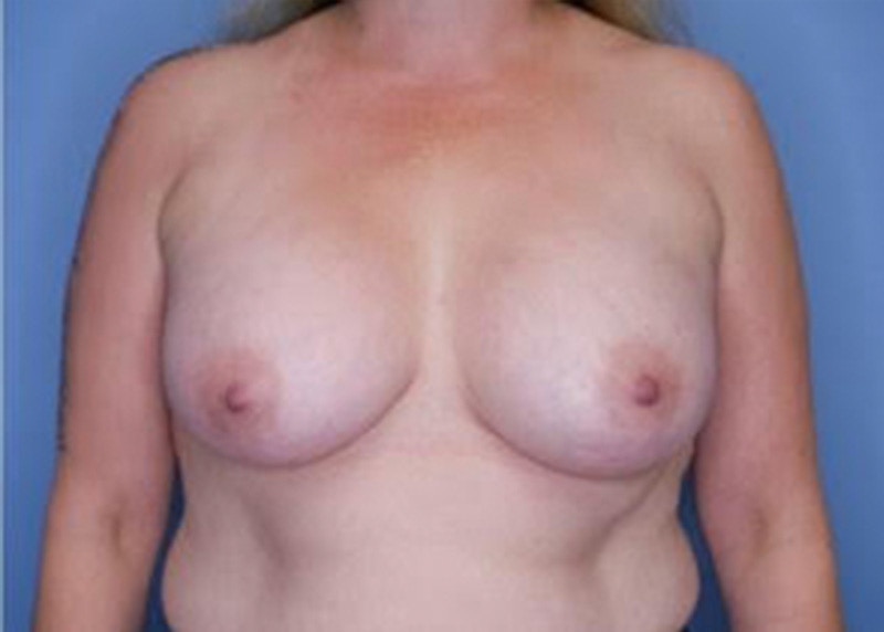 Breast Augmentation Before & After Gallery - Patient 79321588 - Image 2