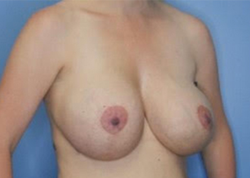 Breast Augmentation Before & After Gallery - Patient 79311777 - Image 1