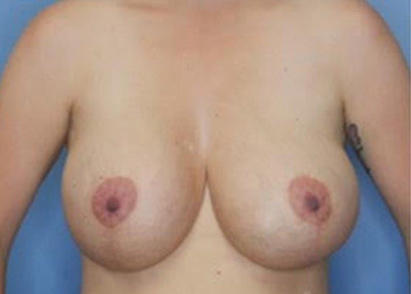 Breast Augmentation Before & After Gallery - Patient 79311777 - Image 3