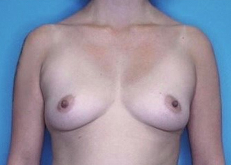 Breast Augmentation Before & After Gallery - Patient 77477323 - Image 1