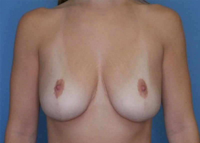 Breast Augmentation Before & After Gallery - Patient 66591775 - Image 1