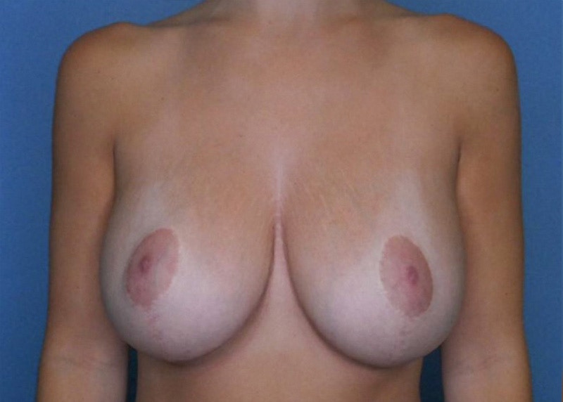 Breast Augmentation Before & After Gallery - Patient 66591775 - Image 2