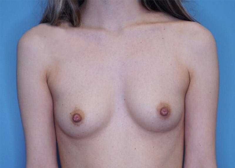 Breast Augmentation Before & After Gallery - Patient 66591776 - Image 1