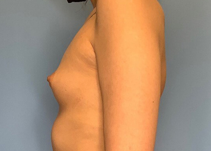 Breast Augmentation Before & After Gallery - Patient 55612927 - Image 1