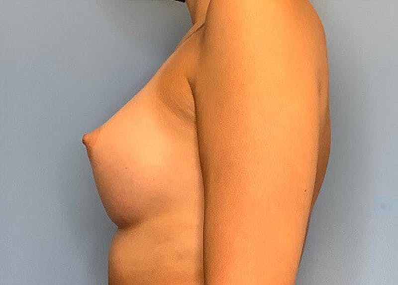 Breast Augmentation Before & After Gallery - Patient 55612927 - Image 2
